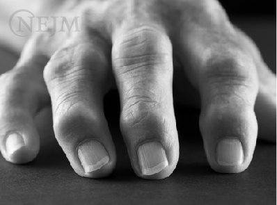 Diagnosing and Predicting Development of Rheumatoid Arthritis