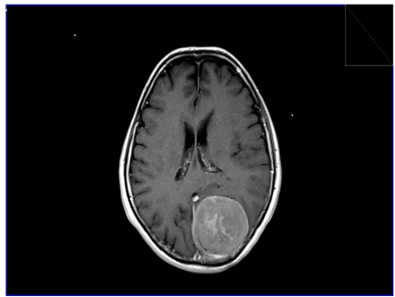 Important Medicine Safety Information Gabapentinoids